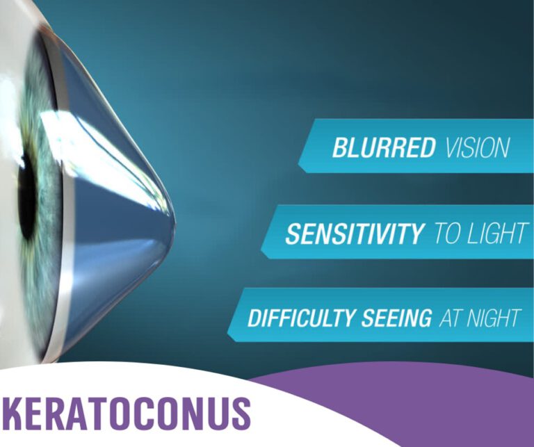 Keratoconus